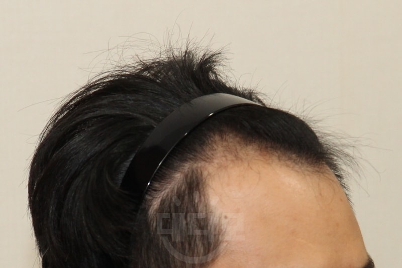 [Cutting/ Day 10 of 1600 hair follicles] Finally, the big scabs fell off on day 10.