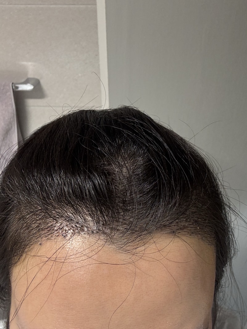女士发际线 2800 毛孔切开后记
