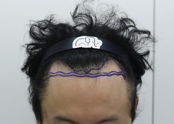 狎鴎亭毛髪移植、マンモスヘアライン手術翌日の写真添付