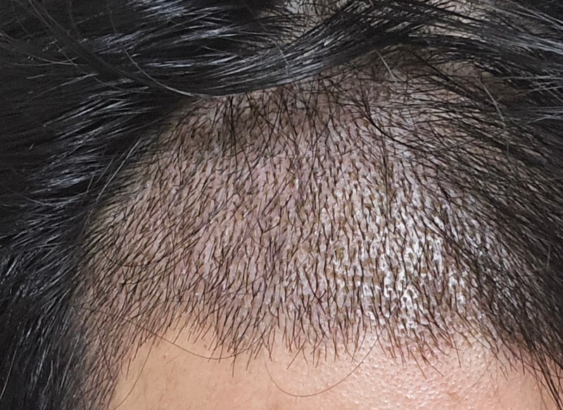 이식 10일차-1.jpg