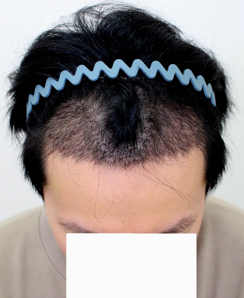 이식 17일차-1.jpg