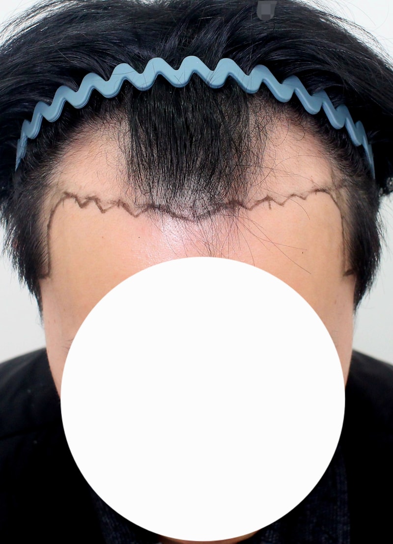 모프로의원, 모발이식 비절개 5000모, 17일 차 후기