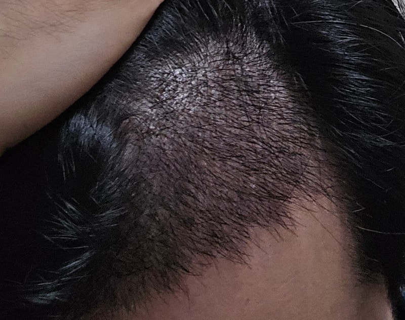 이식 17일차-3.jpg