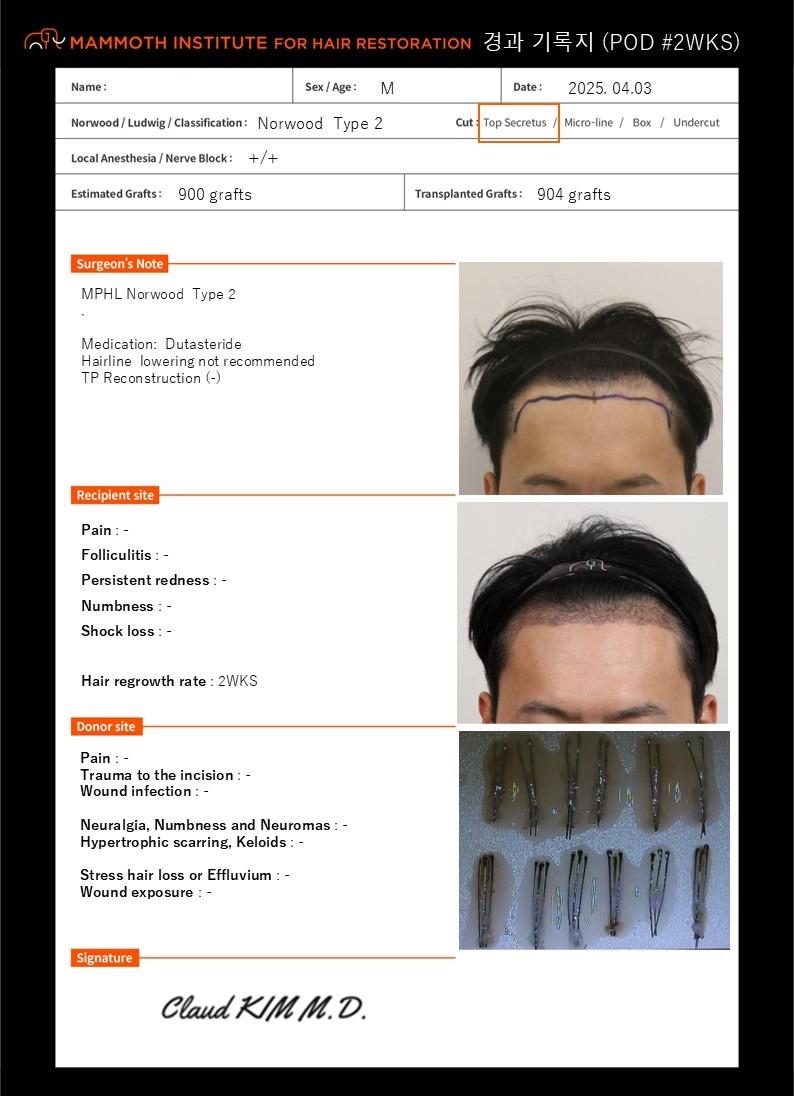 It's a two-week review of M-shaped hair transplantation in Busan.