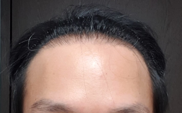ニューヘア毛髪移植レビュー
