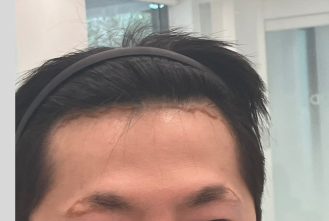 モディヘアプラントでヘアラインと眉毛を一緒に植えてきましたね