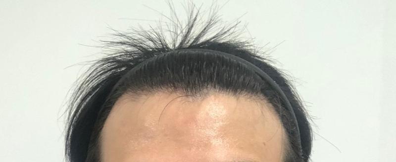 モディヘアプラント 2000 毛 非切開 無削髪 6ヵ月になりました