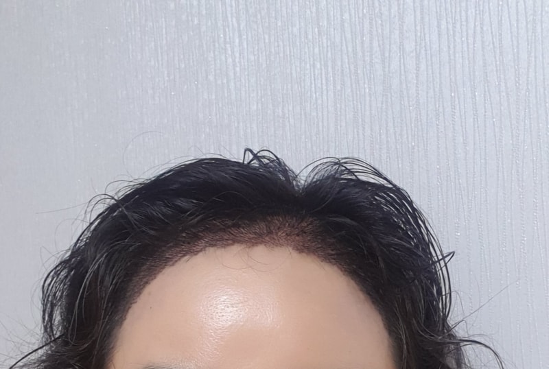 여성헤어라인 다음날 후기