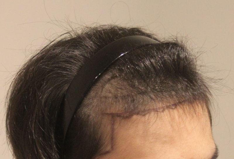 New Hair Non-Cutting Hair Transplantation 1430 Late 6 Months of Hair follicle