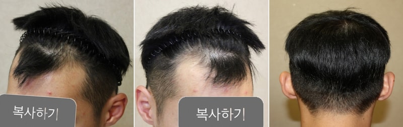 비절개 2800모 3주정도 됬네요 -0-