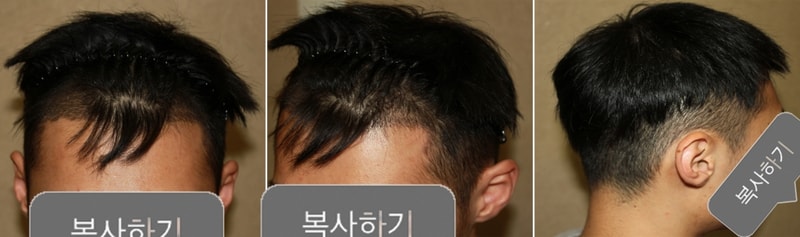 수술후_2.jpg