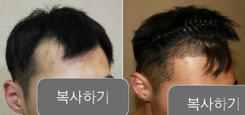 수술전후.jpg
