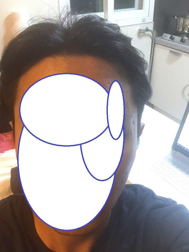 2200모 모발이식 후기(수술후 2년 3개월개월)