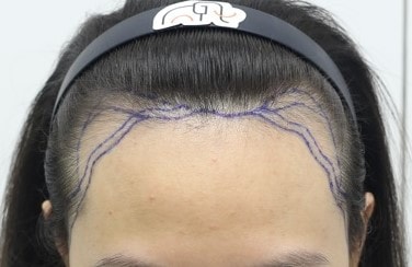 狎鴎亭マンモスヘアラインの医院非切開ヘアライン矯正1日目です
