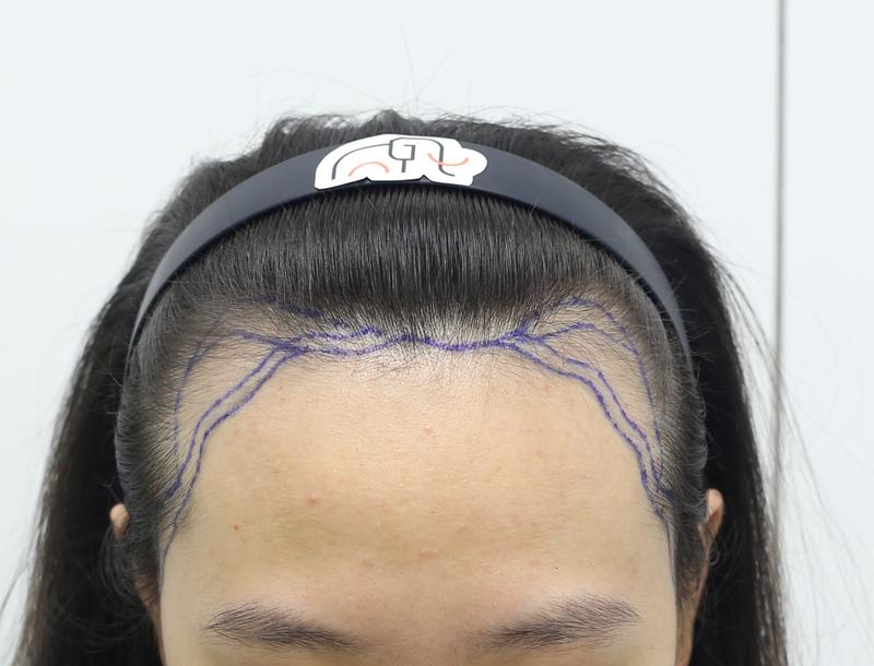 狎鴎亭マンモスヘアライン 医院 非切開 ヘアライン 矯正 7ヶ月