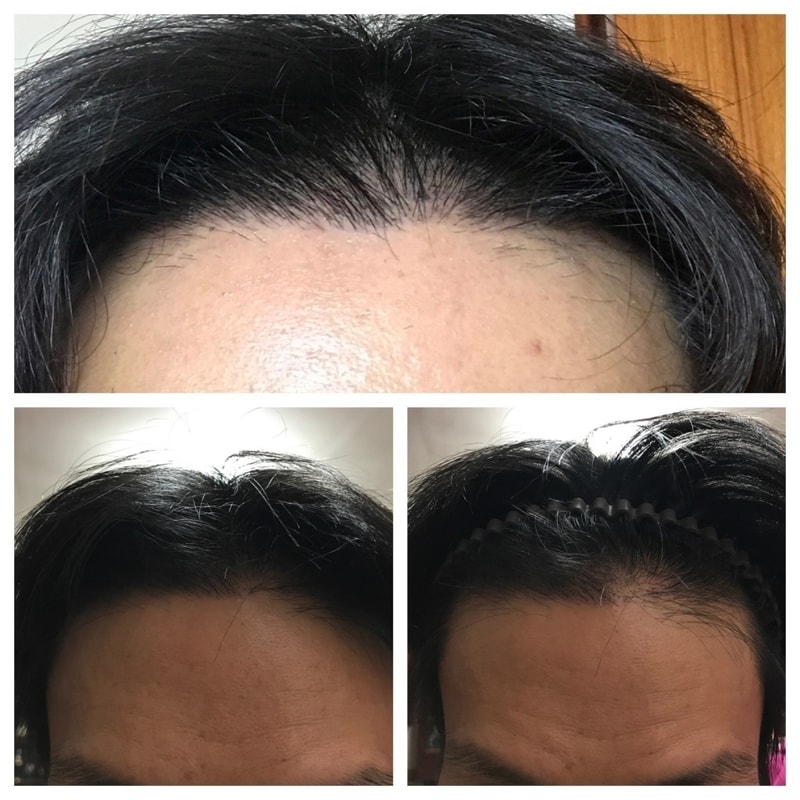 New Hair 1,500毛囊 4个月了 (黑暗期应该结束了吧？)