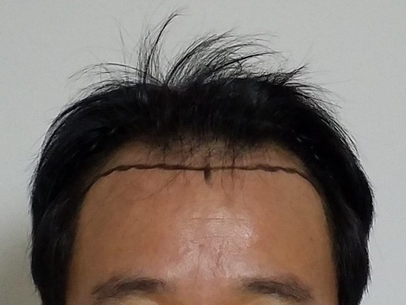 1월28일 두피검사, 피검사.jpg