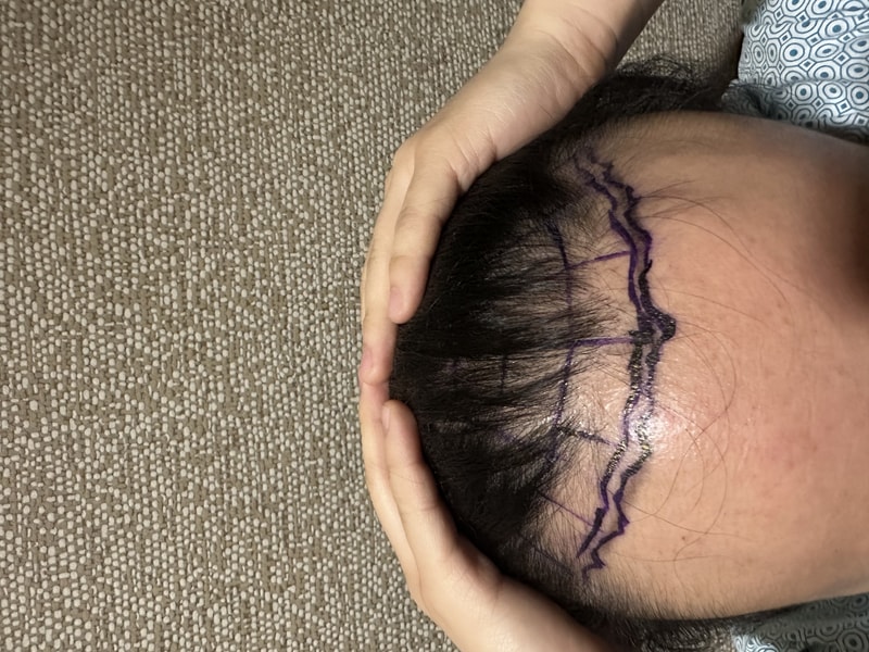 뉴헤어 강남모발이식병원 절개 2500모낭 모발이식 수술 4일차 후기입니다~