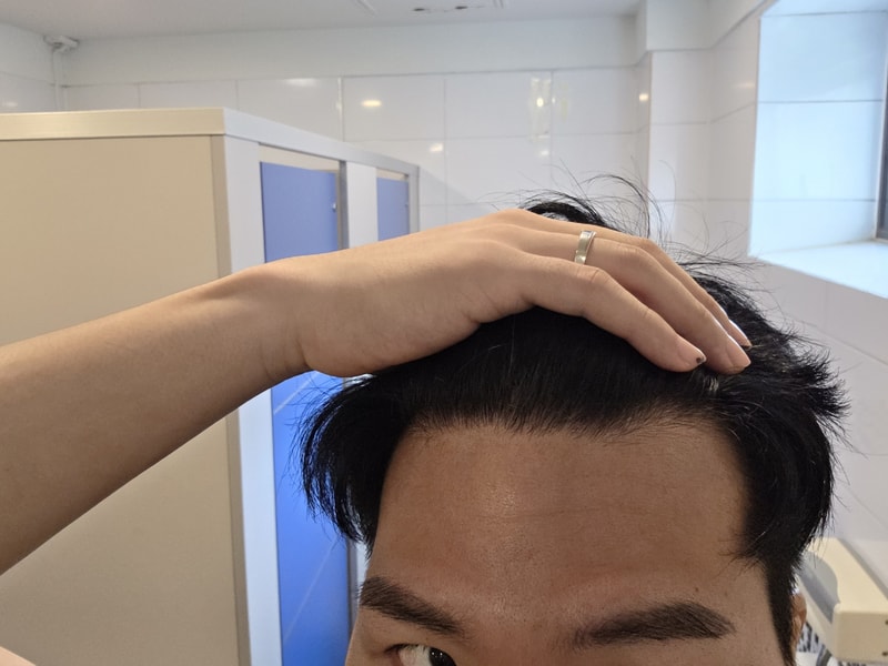 압구정역 모우림의원에서 1500모 이식 후기에요
