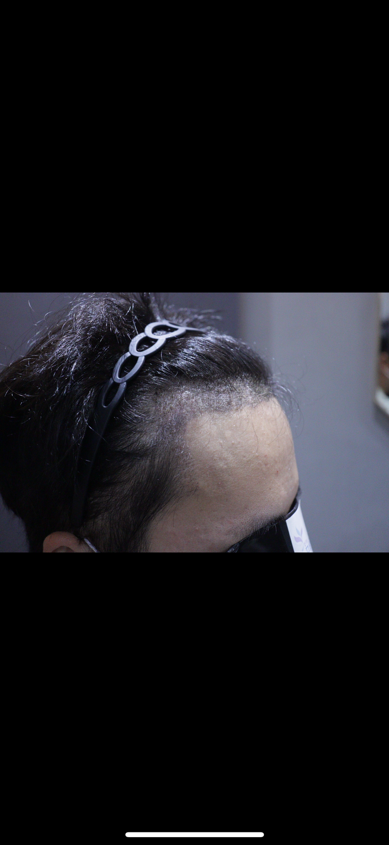 Gwangju Apgujeong Mobiang incision on the 10th day of Hair Transplant