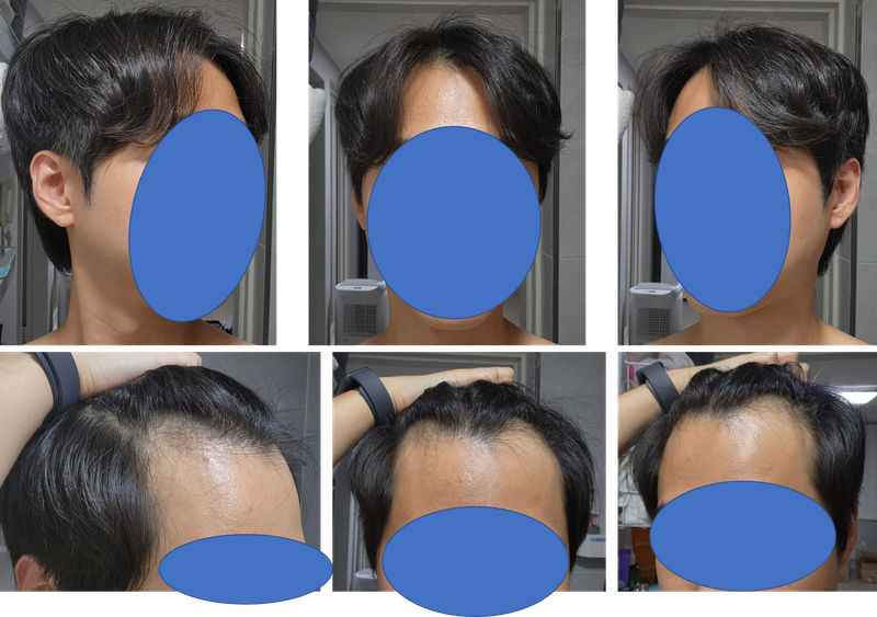 모엠의원 전지훈 원장님 2700모 견적, 실제 3016모 후기 - 수술 전, 직후 1일차, 3일차, 5일차, 10일차, 15일차