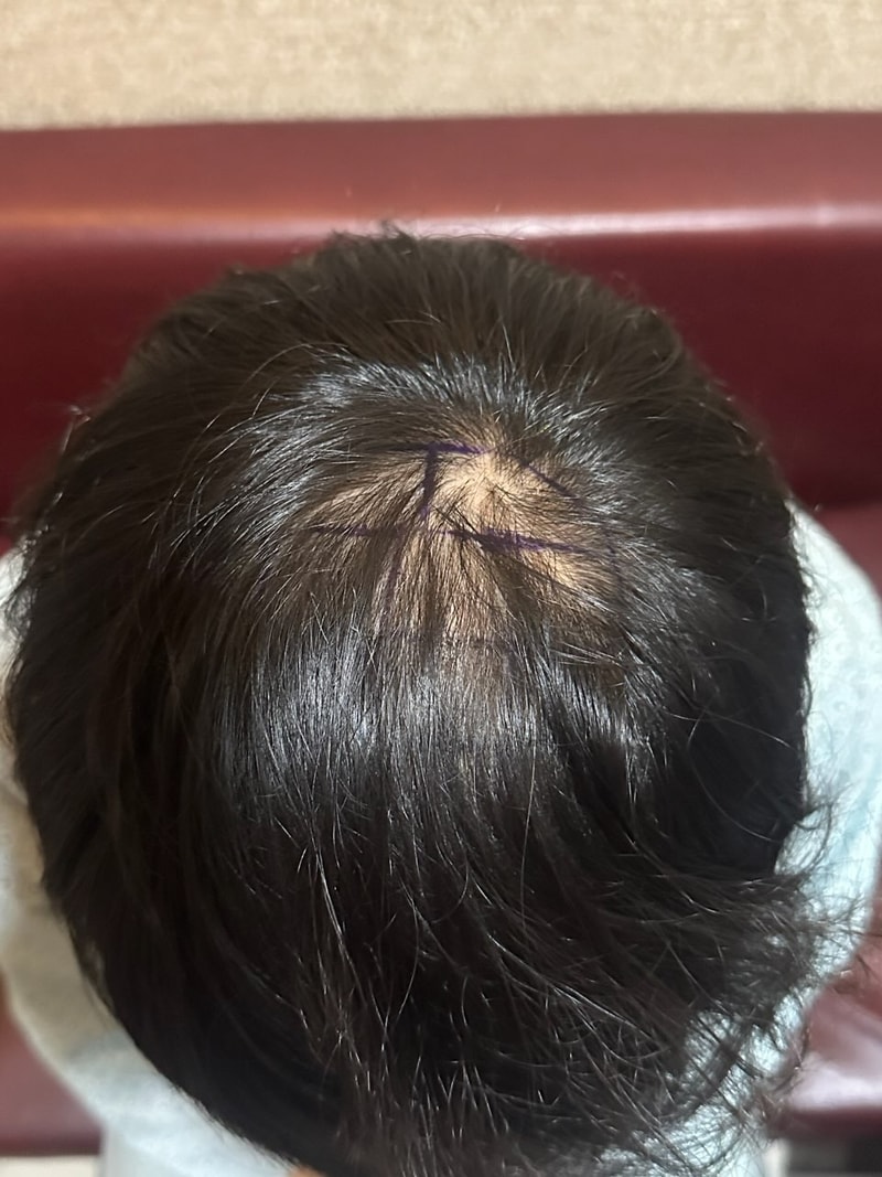 뉴헤어 정수리 1500모낭 비절개 모발이식 수술후기입니다