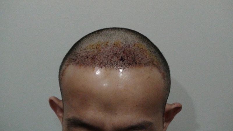 수술후1일.jpg