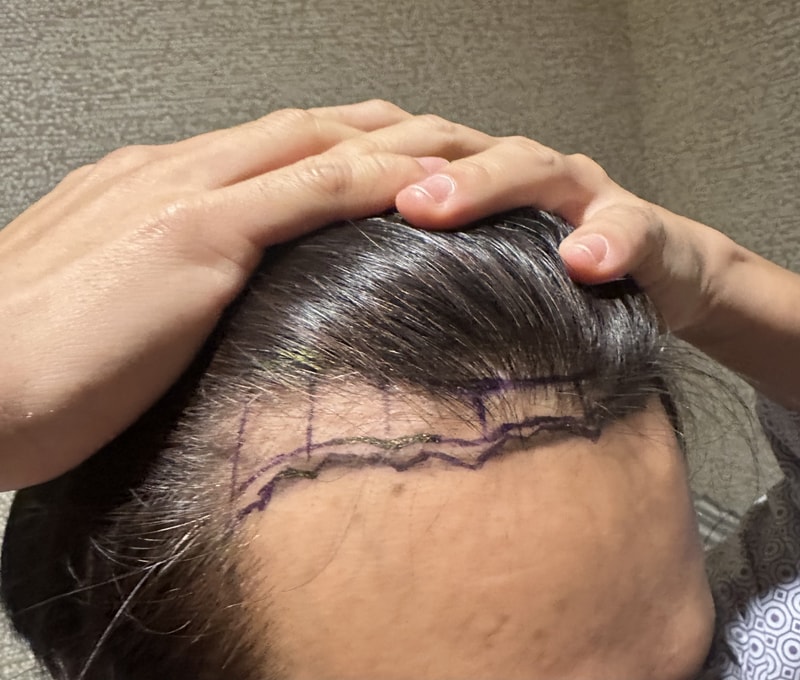 뉴헤어 2일차 비절개 모발이식 1000모낭 후기