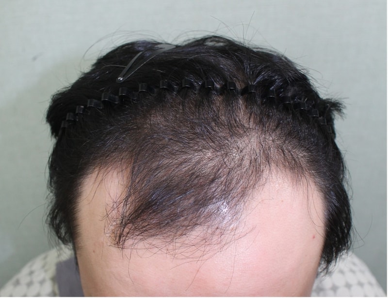 M-shaped incision 4,000 hair warm transplant review