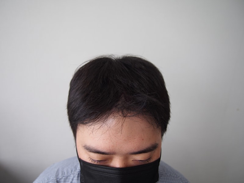 母材性2次手術の1年経過後です。