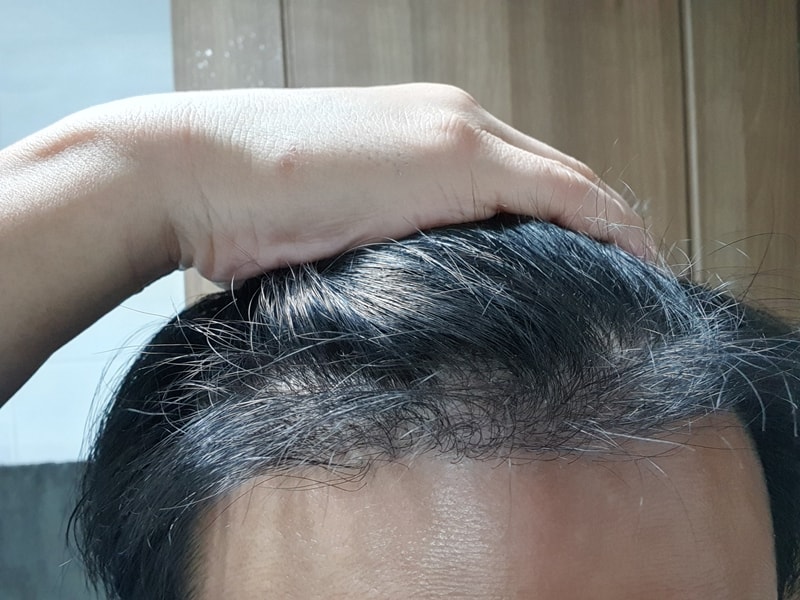Six months of hair transplantation