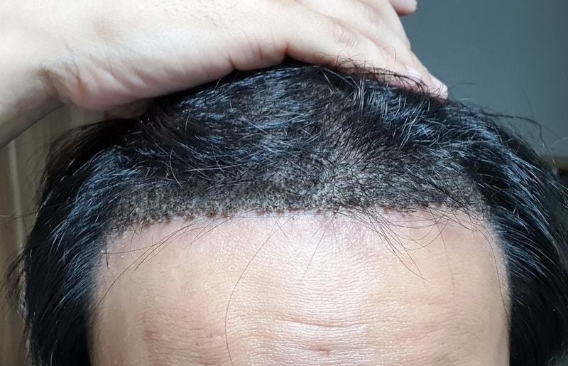 2nd Week of Hair Transplantation