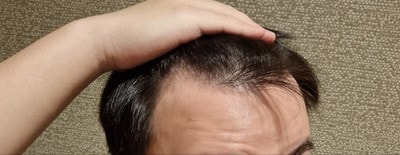 New Hair Non-Cutting Hair Transplantation 2000 Hair follicles (4,000 hair) Day 4 Late