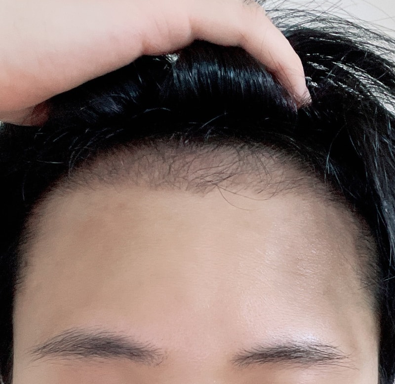 New Hair Non-Cutting Hair Transplantation 1700 Hair follicle 3 Months Late