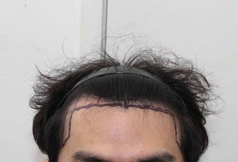 New Hair Slot Hair Transplantation Day 3 of 1900 Hair follicles