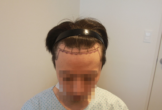 ニューヘア 毛髪移植 ヘアライン矯正 1200毛包 3ヶ月目 レビュー