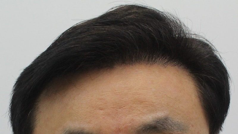 수술후.jpg