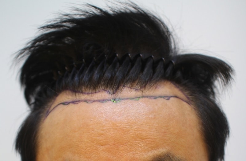 크기변환_수술전.jpg