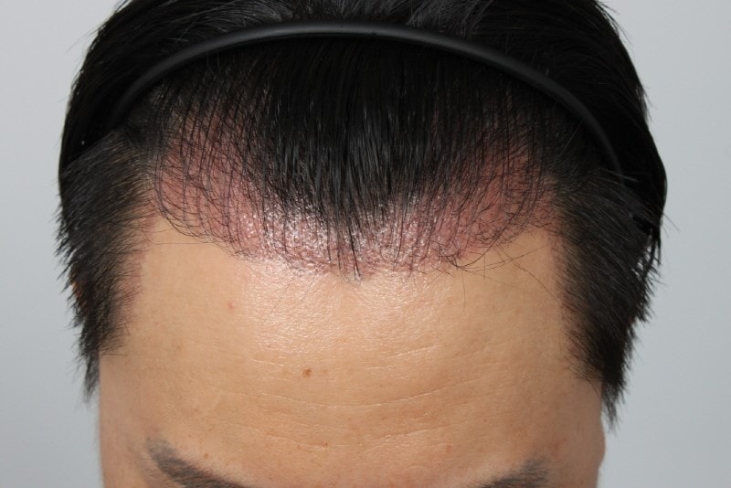 2.이식 한달후.JPG