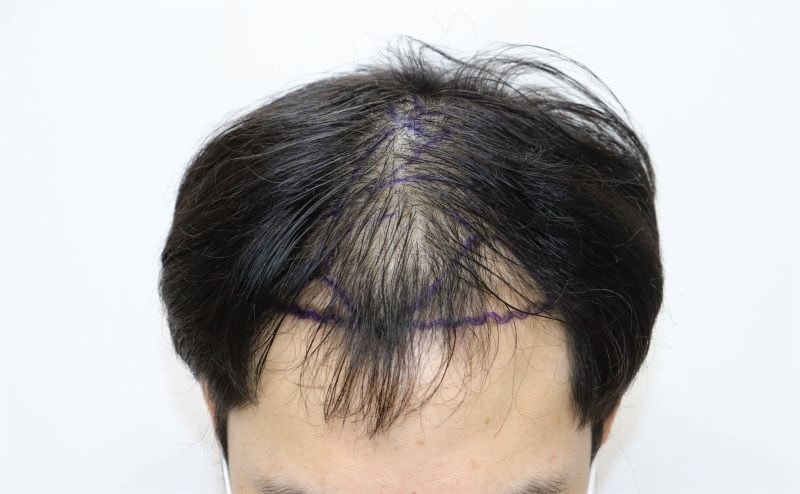 非切開毛髪移植4ヵ月目の後期ポヘア大邱店で1700毛包植えました
