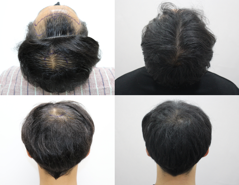Daegu forehair detail comparison 3,800 hair transplants 4 months old