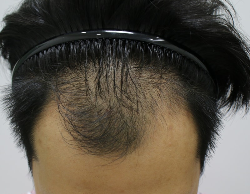 7ヶ月が過ぎた植毛後の体験談