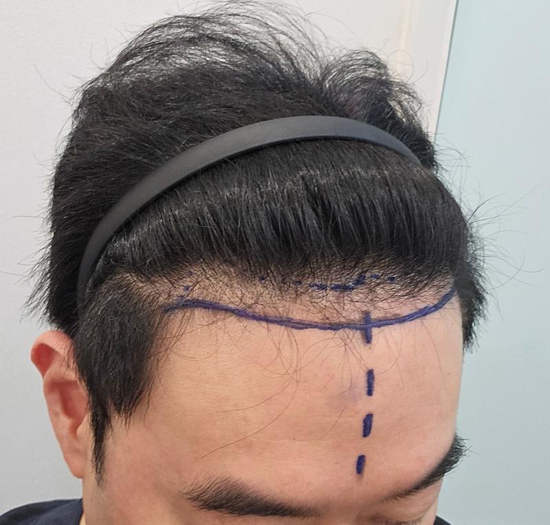 無削髪 ヘアライン+整数 非切開毛髪移植 1280毛包 7ヶ月 毛源 整形外科