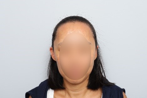 모발이식 포토후기
