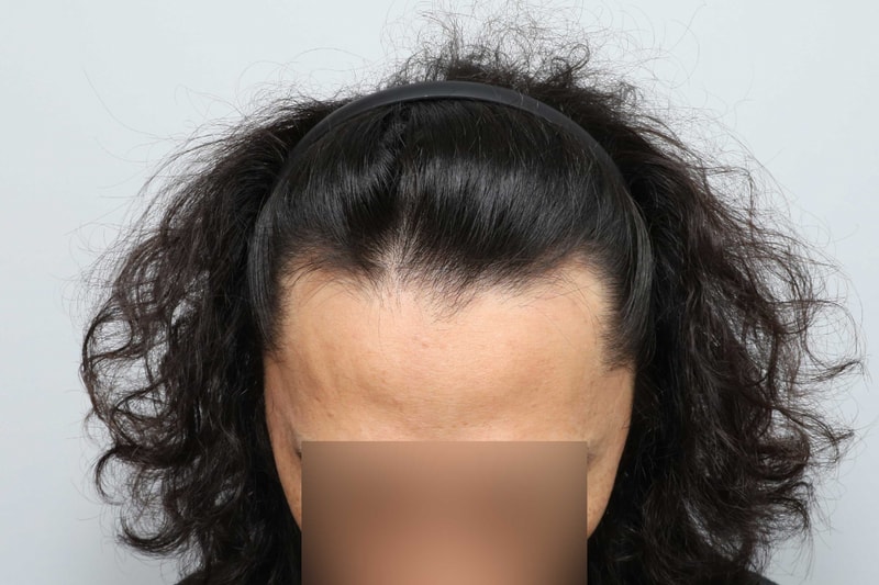 헤어라인 무삭발 비절개모발이식 1년차 모원성형외과