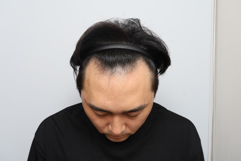 부분삭발 비절개 모발이식 1년 모원성형외과