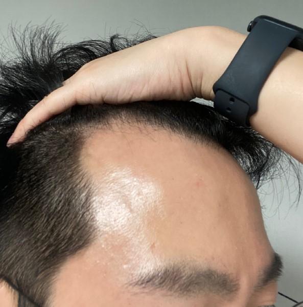 Mawon Plastic Surgery M Zaima Non-Cutting Hair Transplantation 7 Months (Director Jeong Jae-hong)
