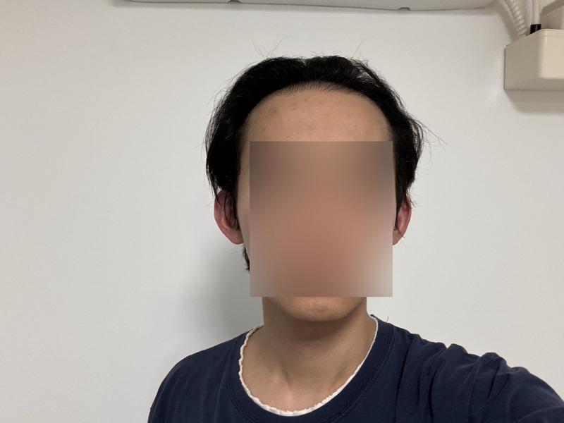 モウォン整形外科 ヘアライン再手術1日目のチョン·ジェホン院長