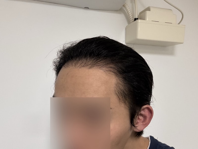 모원성형외과 헤어라인 재수술 3개월차 정재홍원장님