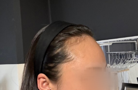 Momwon Plastic Surgery Hairline Non-Cutting Part of the Hairline A month's review! (Director Park Jong-ok)
